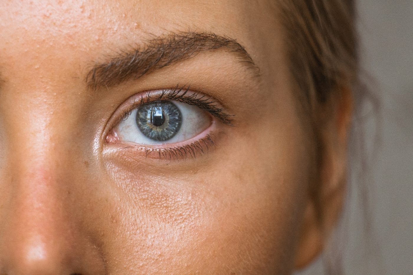 Achieving Clear Skin: A Whole-Body Approach to Acne